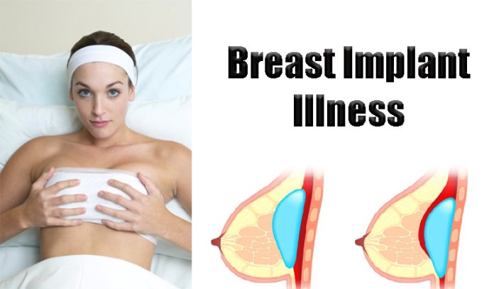 Breast Implant Illness and Treatment Options
