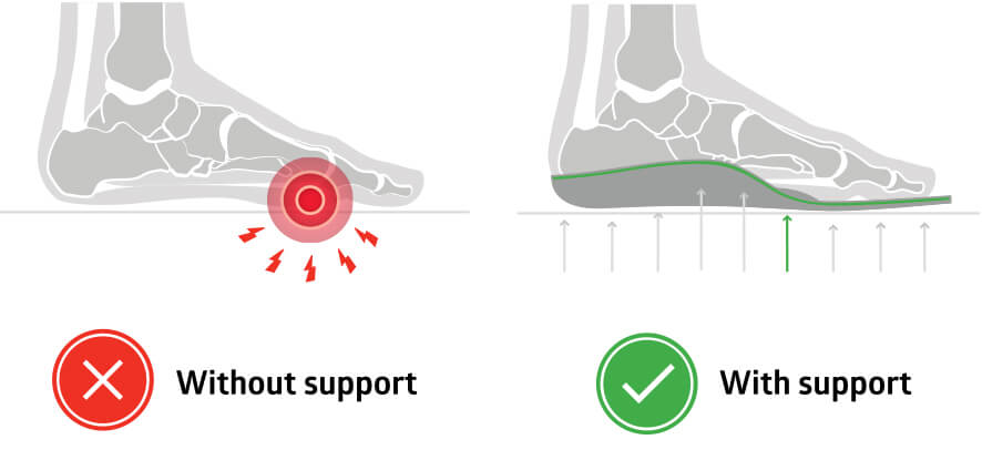 How do modern Insoles Help with Metatarsalgia?