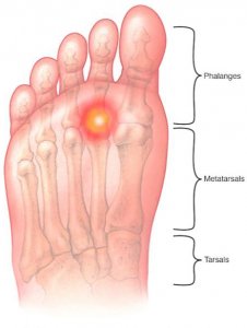 Excess pressure on your forefoot 